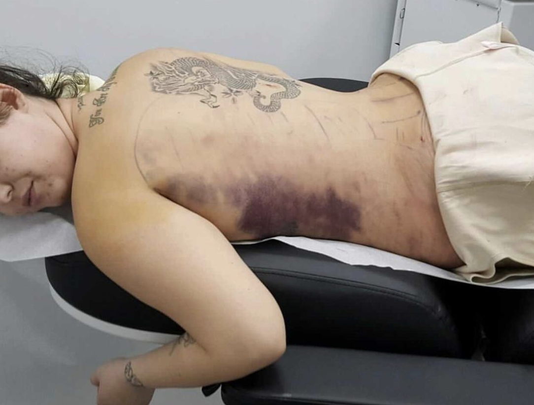 The BBL surgery that only the